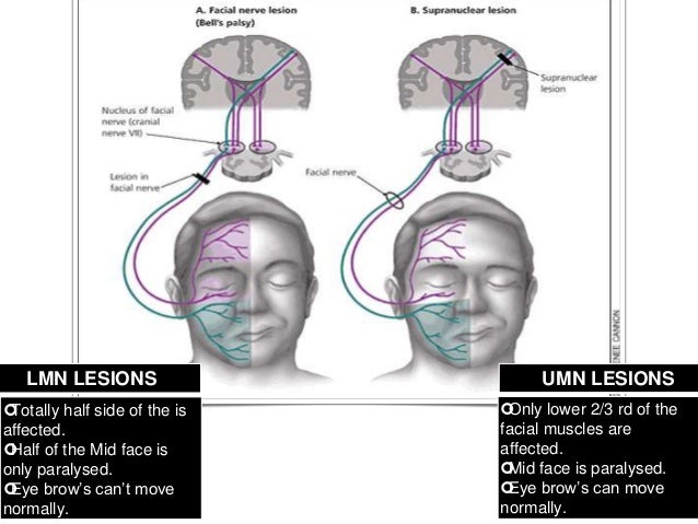 facial nerve lesion Naked asian video